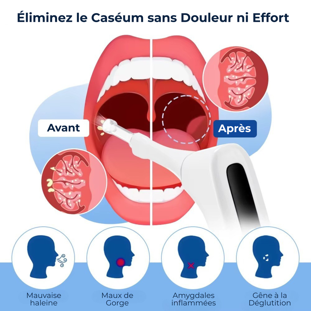 L’Aspirateur à Caséum TSR Pro - Nettoyage et Prévention du Caséum 360°